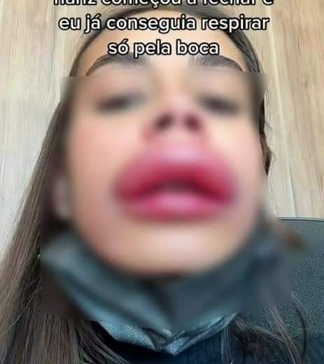 عملية تجميل فاشلة تشوه وجه فتاة بشكل غريب